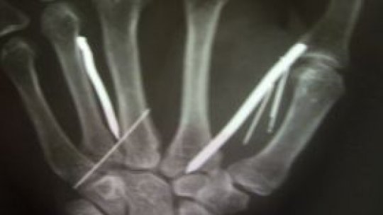 O menajeră a fost străpunsă cu 24 de cuie